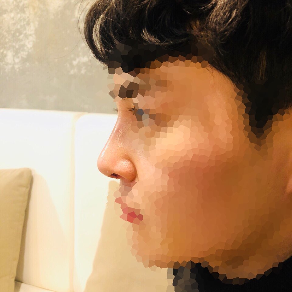 Rhinoplasty성형 후기요~ (1주일)